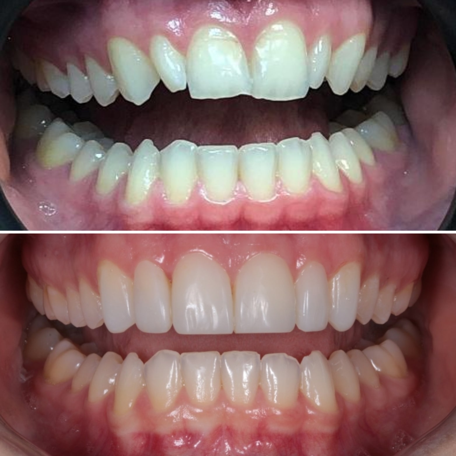 Invisalign results near you in Stockport